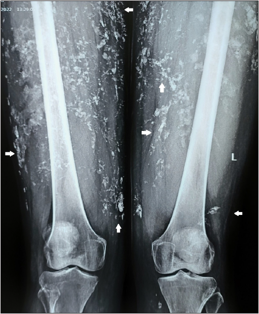 Anti-Mi-2 antibody–associated atypical dermatomyositis with extensive