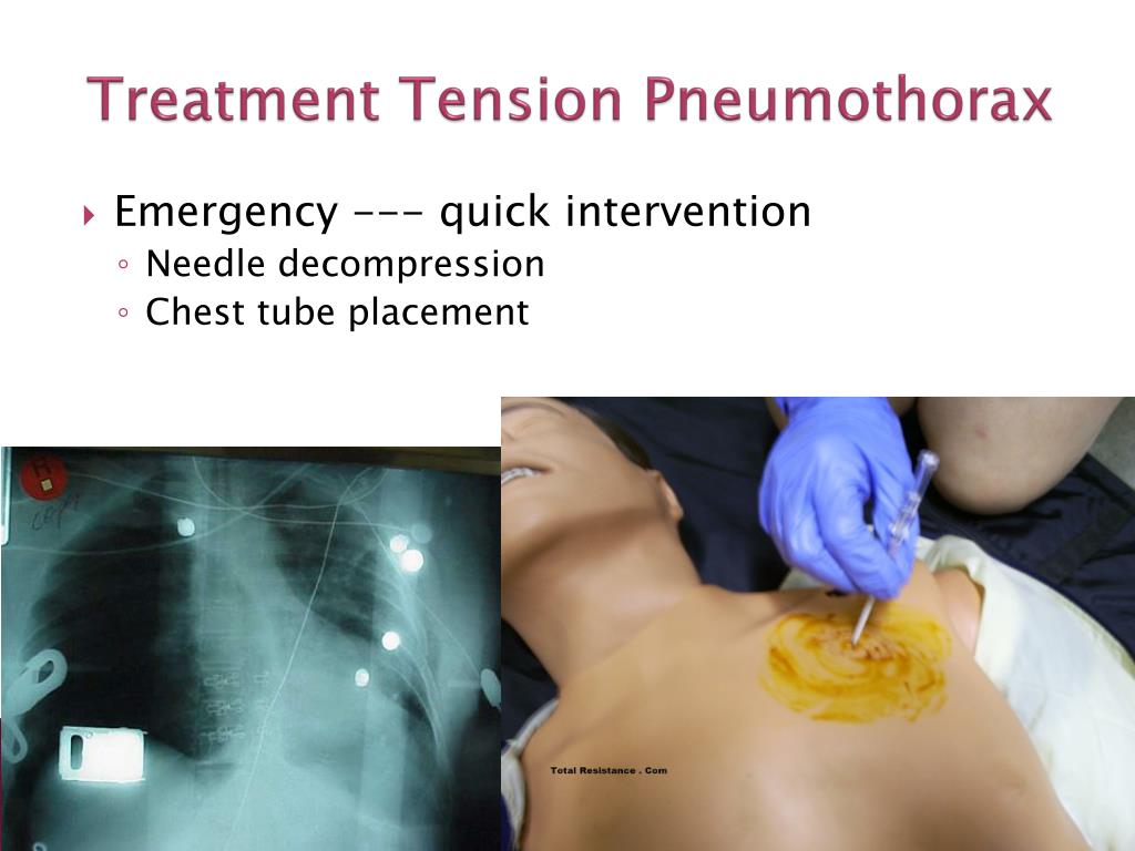 PPT - Respiratory Disorders: Pleural and Thoracic Injury PowerPoint